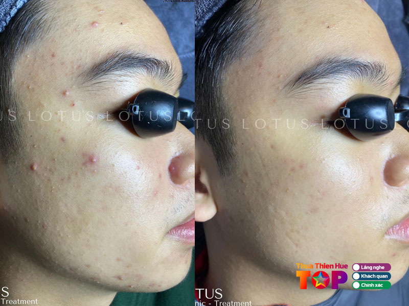 lotus-spa-huetoplist