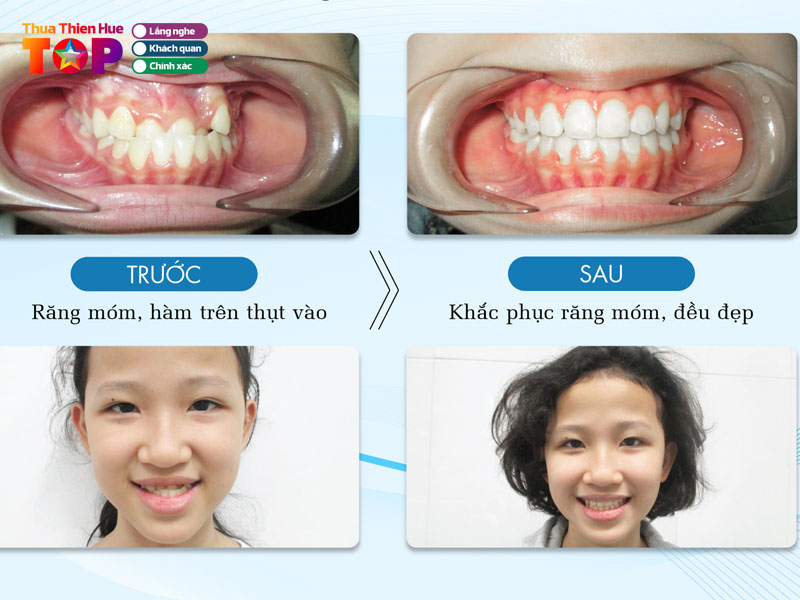 nha-khoa-phu-hoan-my-huetoplist