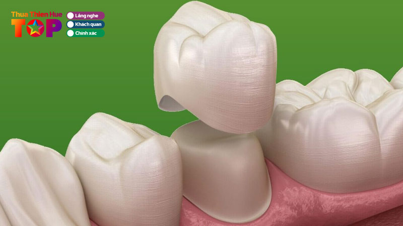 top-10-dia-chi-boc-rang-su-tai-hue-dep-ben-gia-uu-dai-huetoplist