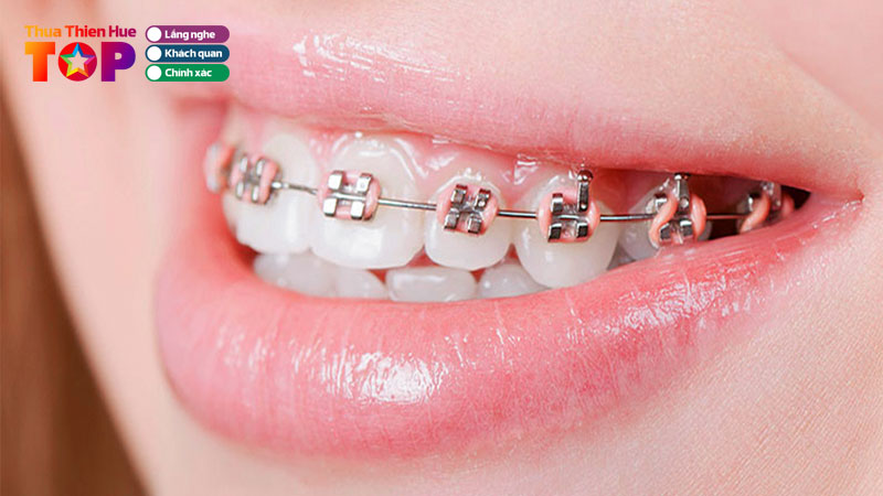 top-10-dia-chi-nha-khoa-nieng-rang-tai-hue-chat-luong-huetoplist