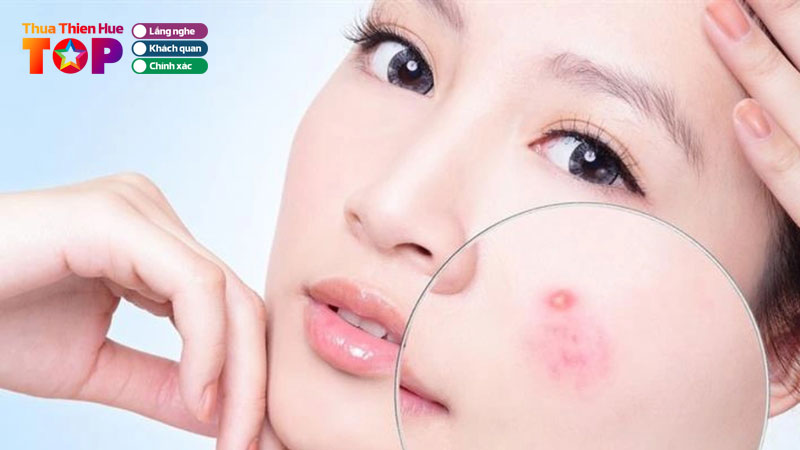 Bi-quyet-xoa-seo-mun-than-ky-chi-co-tai-tham-my-vien-diva-huetoplist