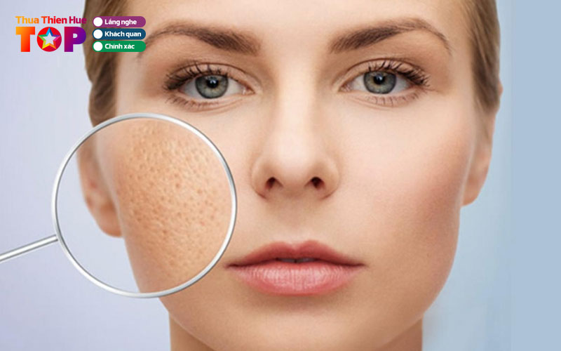 Cac-loai-seo-mun-pho-bien-hien-nay-huetoplist