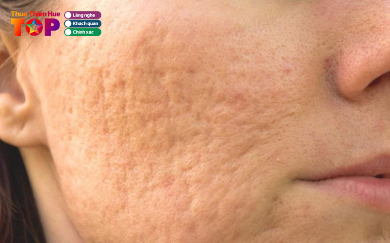 Mot-so-luu-y-khi-dieu-tri-seo-mun-ban-nen-biet-huetoplist