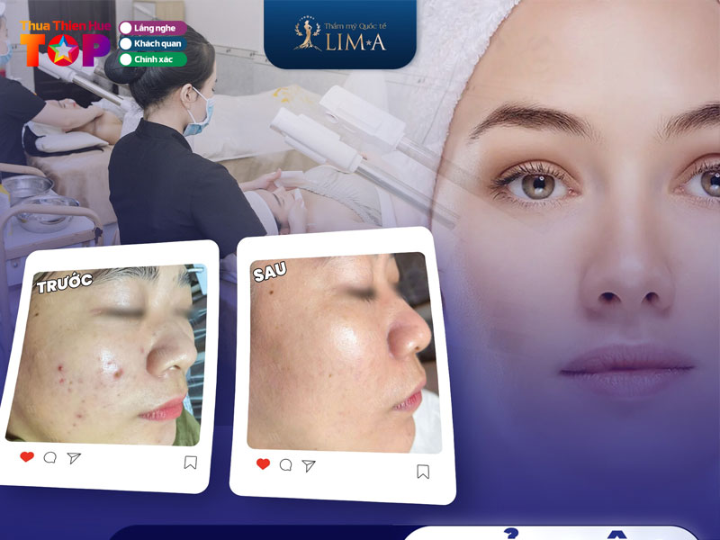 Tham-my-quoc-te-lim-a-huetoplist