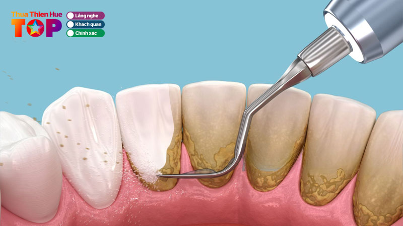 Top-10-dia-chi-chuyen-cao-voi-rang-hue-an-toan-uy-tin-huetoplist