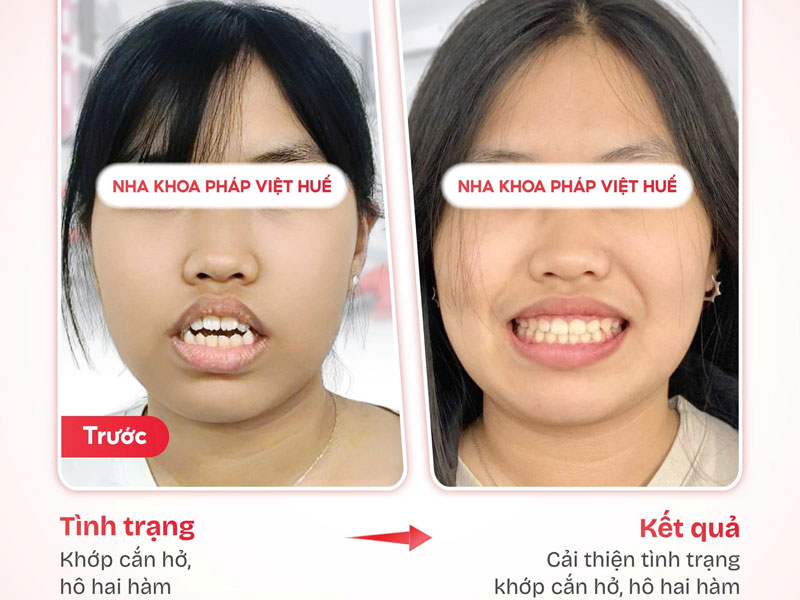 Nha-khoa-phap-viet-huetoplist