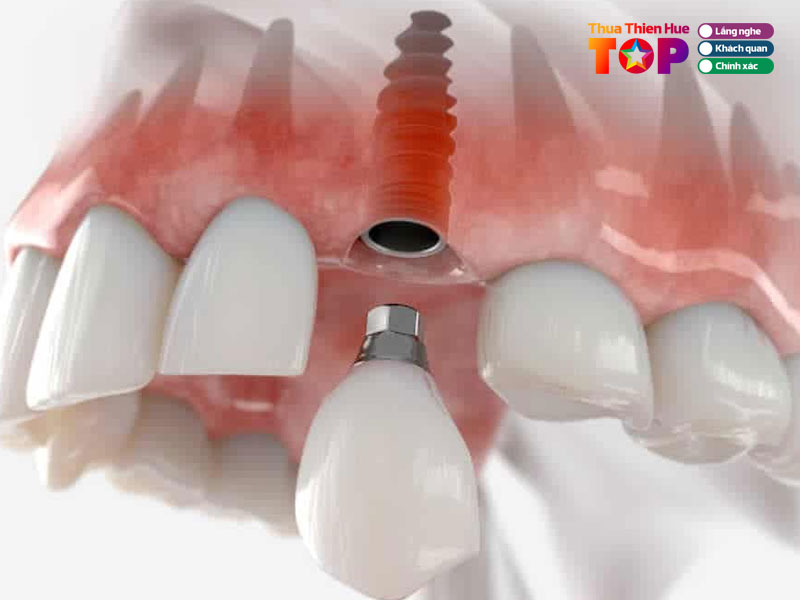 Tieu-chi-chon-dia-chi-trong-rang-implant-o-hue-huetoplist