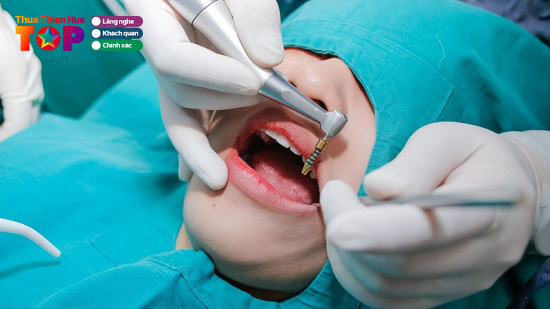 Top-11-dia-chi-trong-rang-implant-o-hue-an-toan-hieu-qua-lau-dai-huetoplist