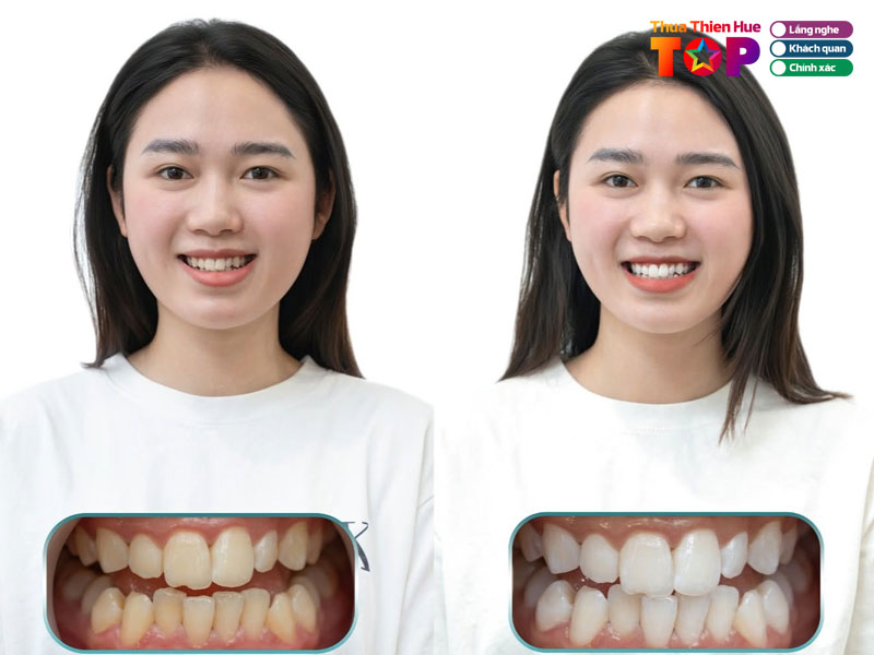 Nha-khoa-livia-dental-huetoplist