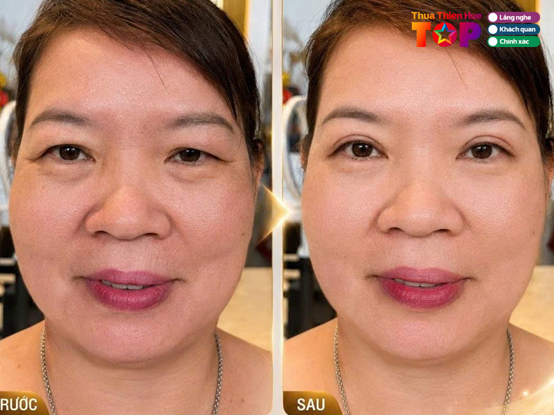 Tham-my-truong-kieu-xuan-huetoplist